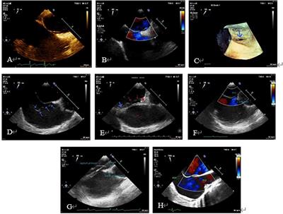 Transesophageal echocardiography guidance for percutaneous closure of PFO and a new method to improve the diagnosis and safety during the procedures